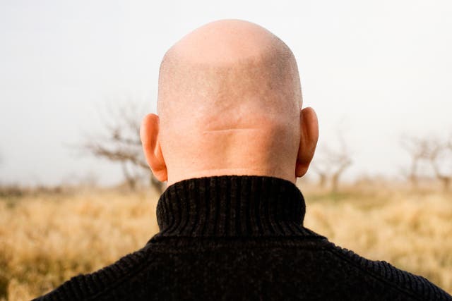 Baldness: Looking your death full in the face will help you to find liberty in life