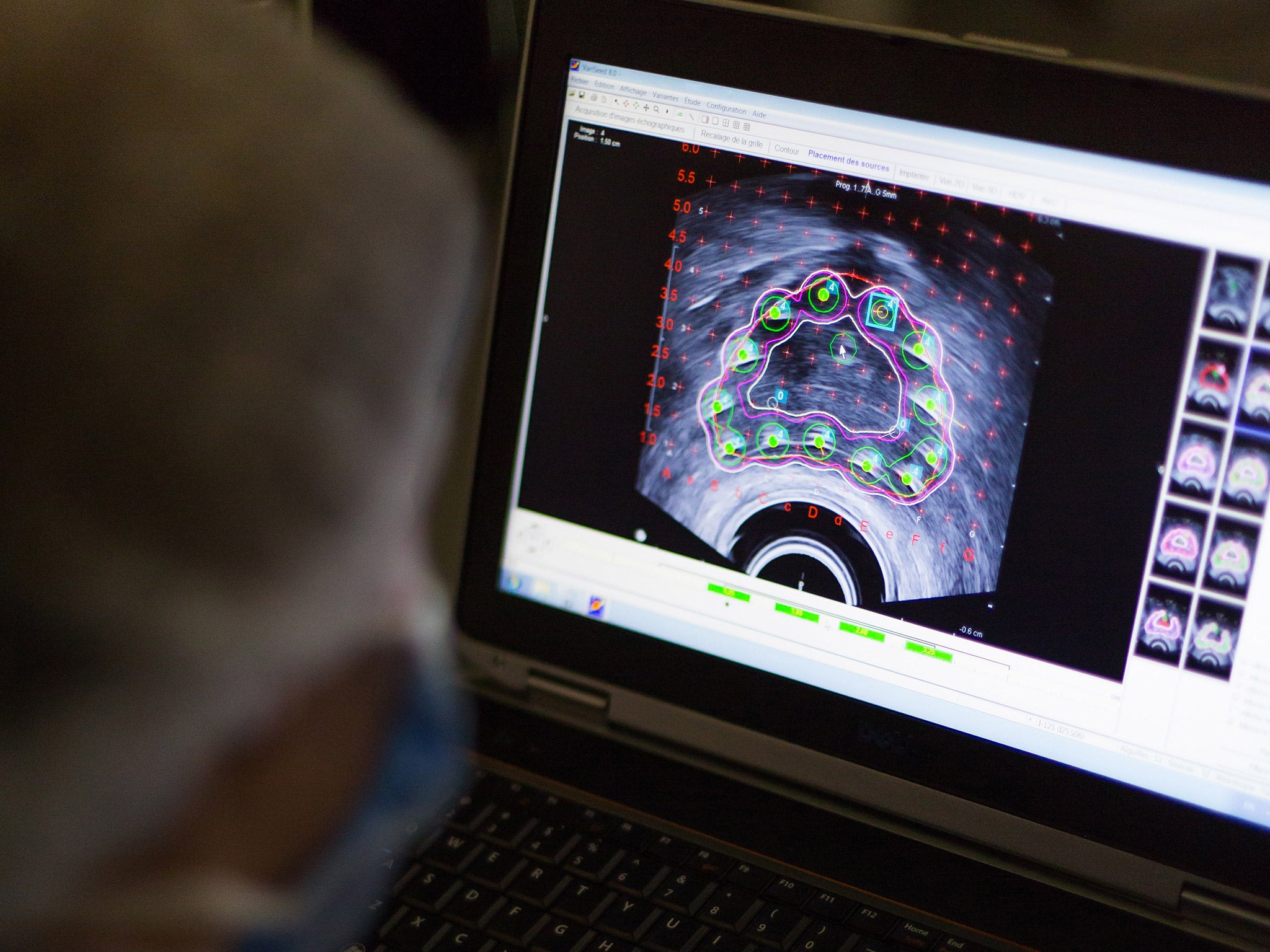 A radiologist examines a prostate X-ray
