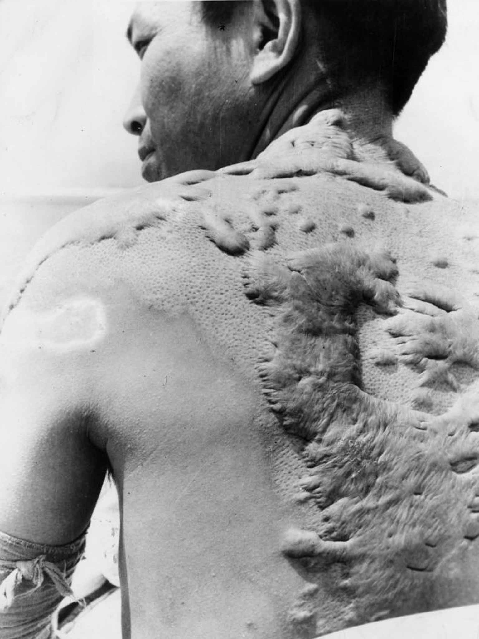 Those who survived suffered horrific burns