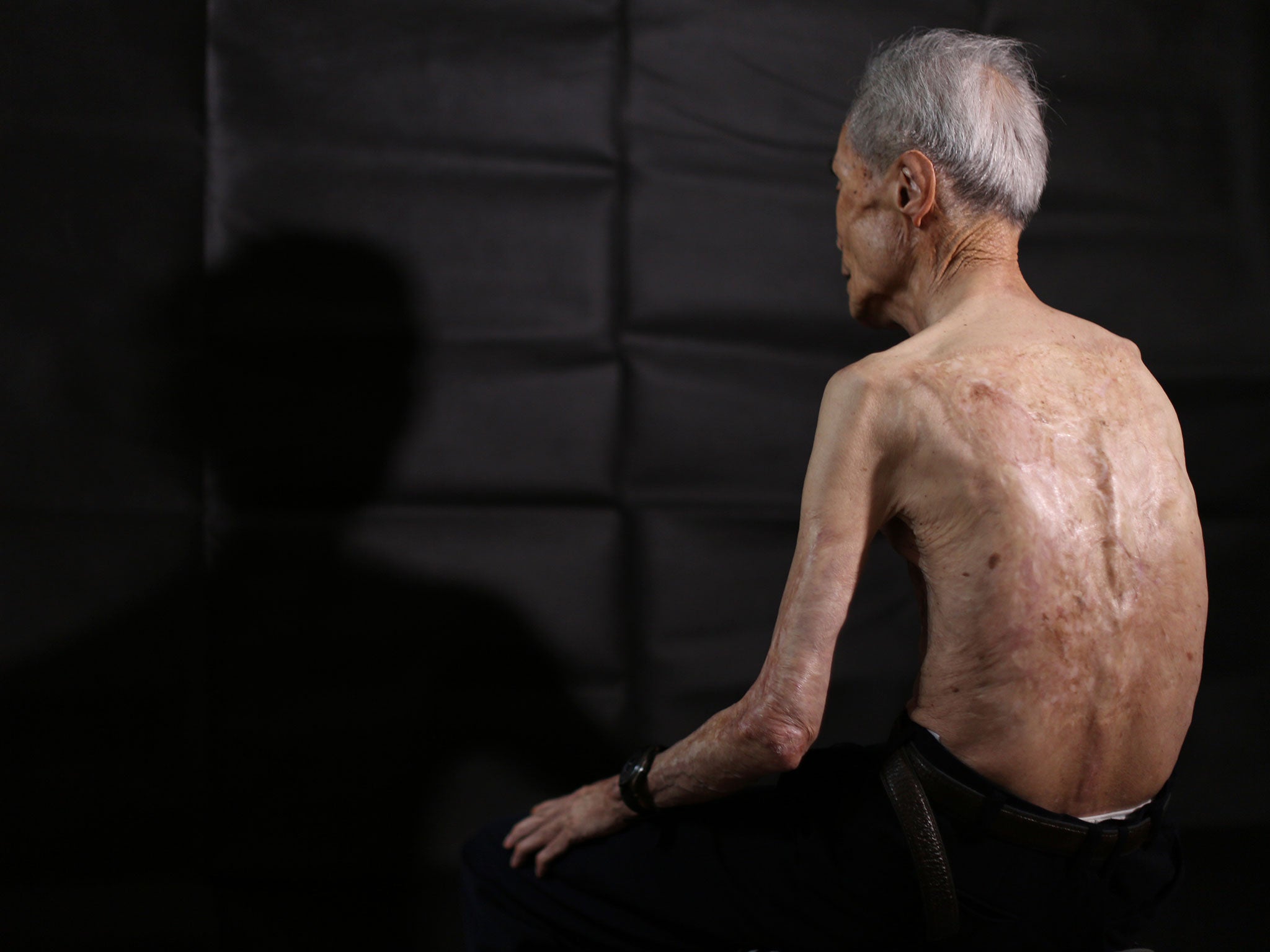 Sumiteru Taniguchi, 86, a survivor of the 1945 atomic bombing of Nagasaki, shows his back with scars of burns from the atomic bomb explosion