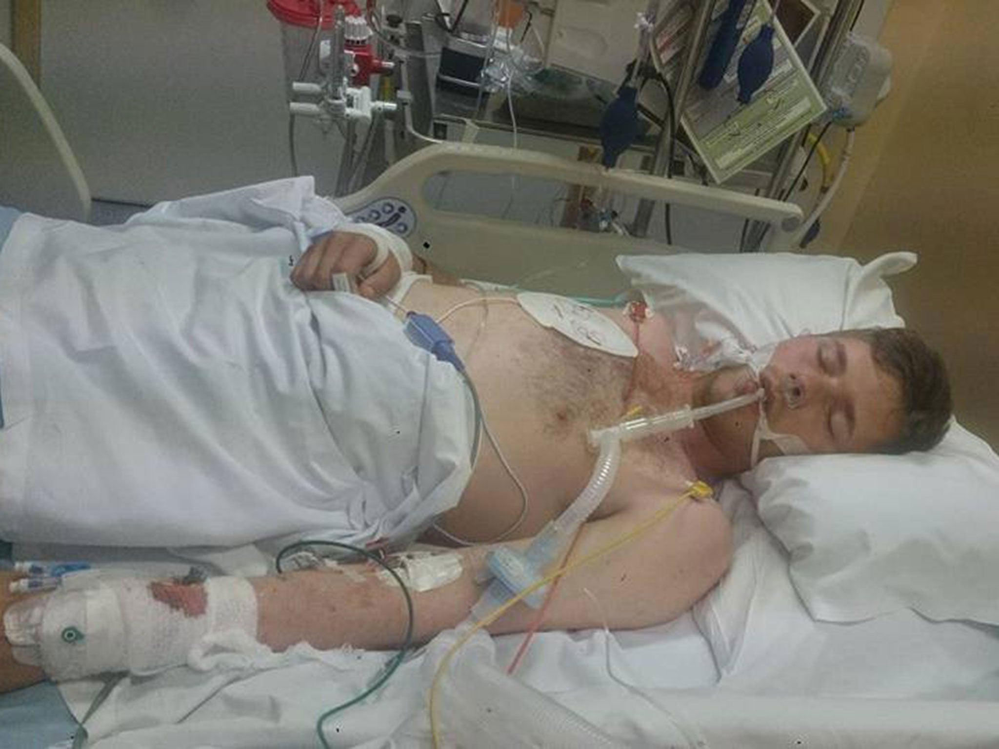 A photograph shared by Jordan Blackburn of himself in an induced coma, which he had been put in after taking legal highs at Kendal Calling