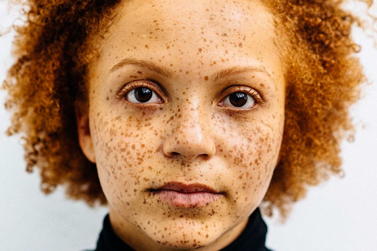ginger melanotan Redhead Gene Doubles Melanoma Risk, Without Sun main image 1
