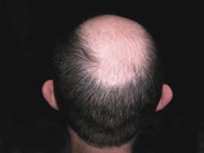 Read more

Hair loss explained: How and why men go bald