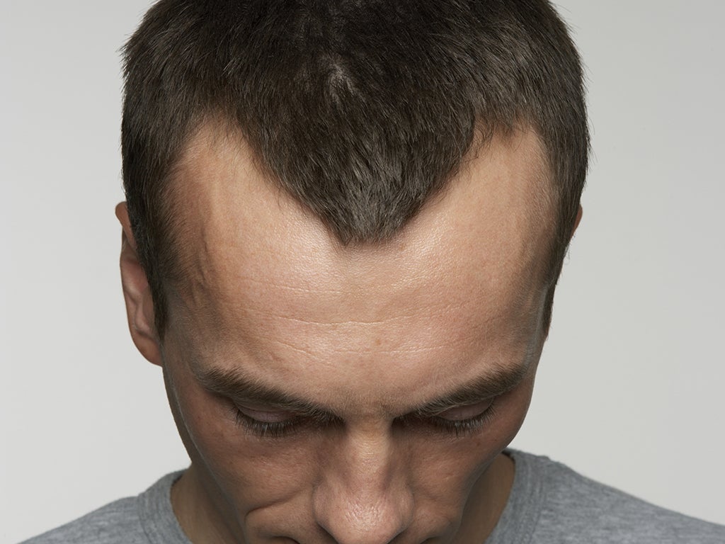 Hair Loss Male Head with Hair Loss Symptoms Front Side Stock Image  Image  of health hairstyle 56233271