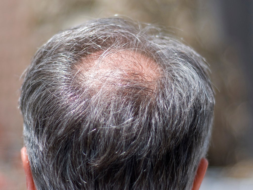 Hair Loss Explained How And Why Men Go Bald The Independent