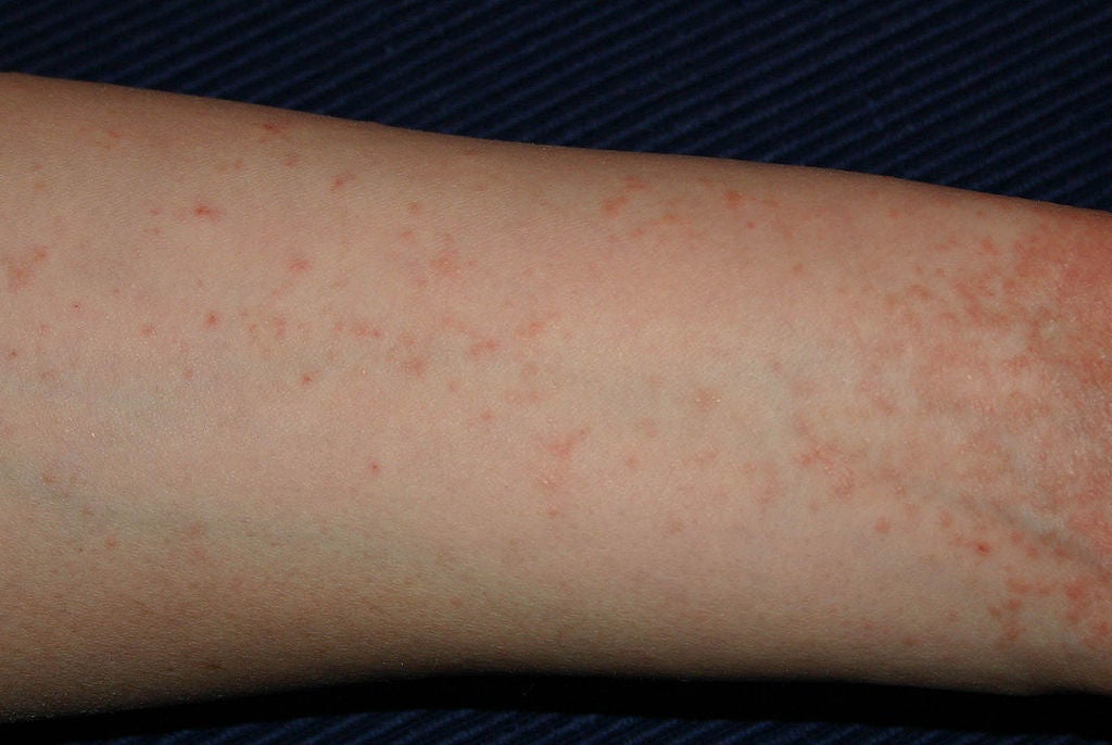 Scabies Images On Black Skin