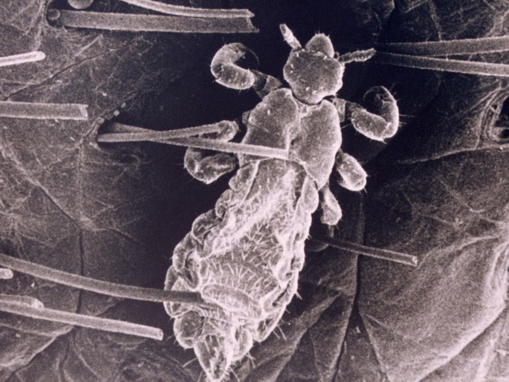 Worst Case Of Head Lice Ever Grim Video Shows Lice Wriggling Across 