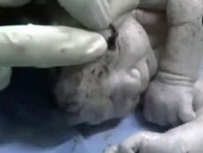 Syrian baby 'born with shrapnel lodged in head'