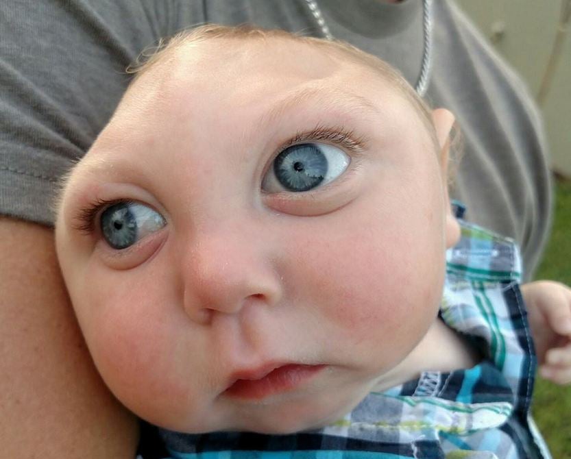 Jaxon was born with a rare birth defect called Microhydranencephaly