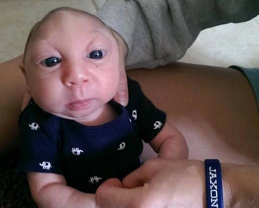 One in 4,859 babies in the US are born with Microhydranencephaly each year