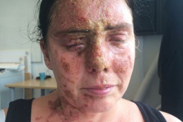 Carla Whitlock was left with horrific burns following the attack
