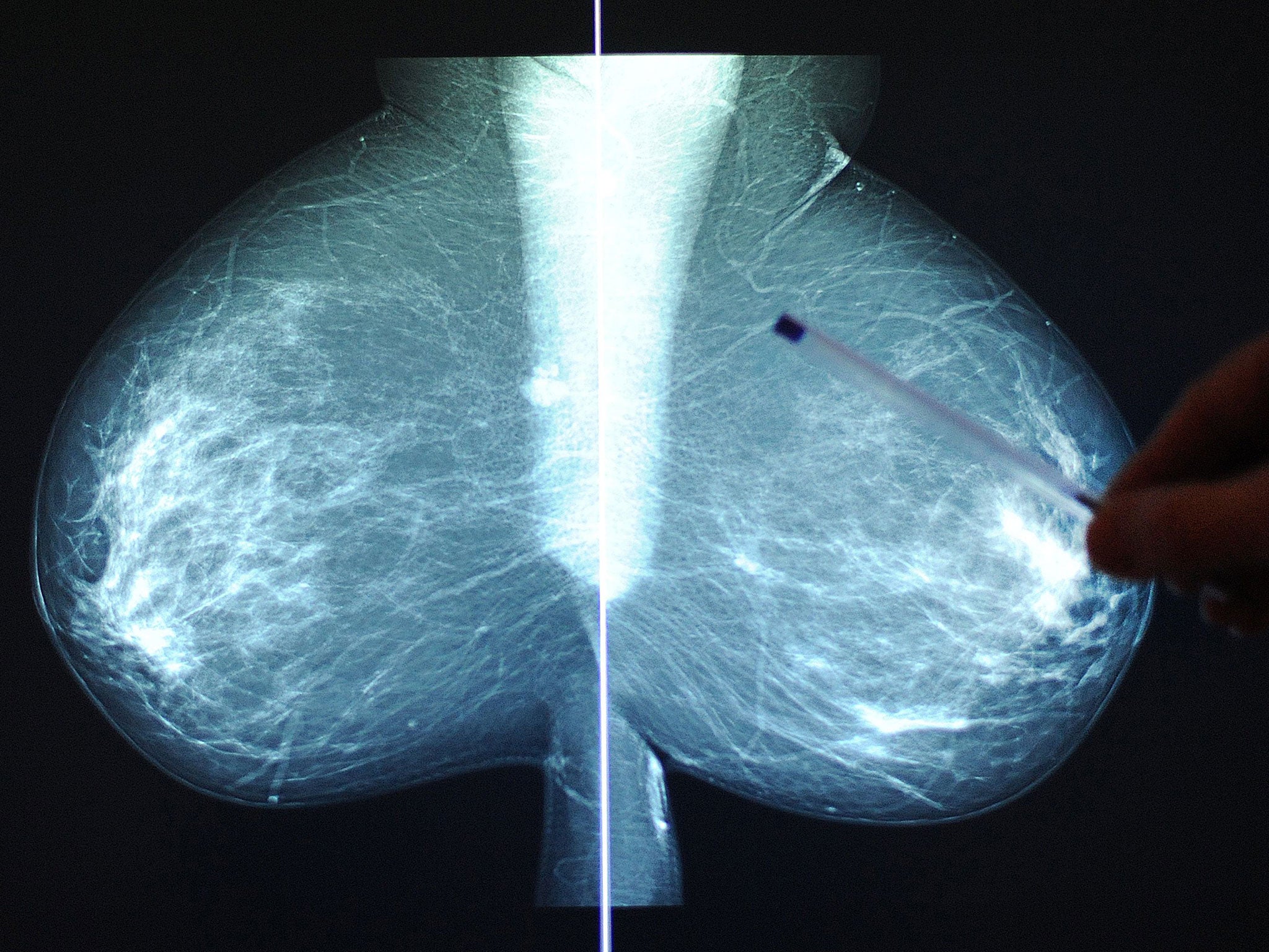 The risk of breast cancer in women increases by 20 per cent for every 10cm increase in height
