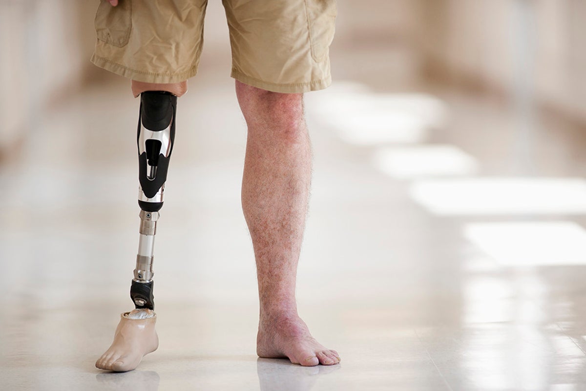 Body Integrity Identity Disorder: the condition where sufferers want to ...