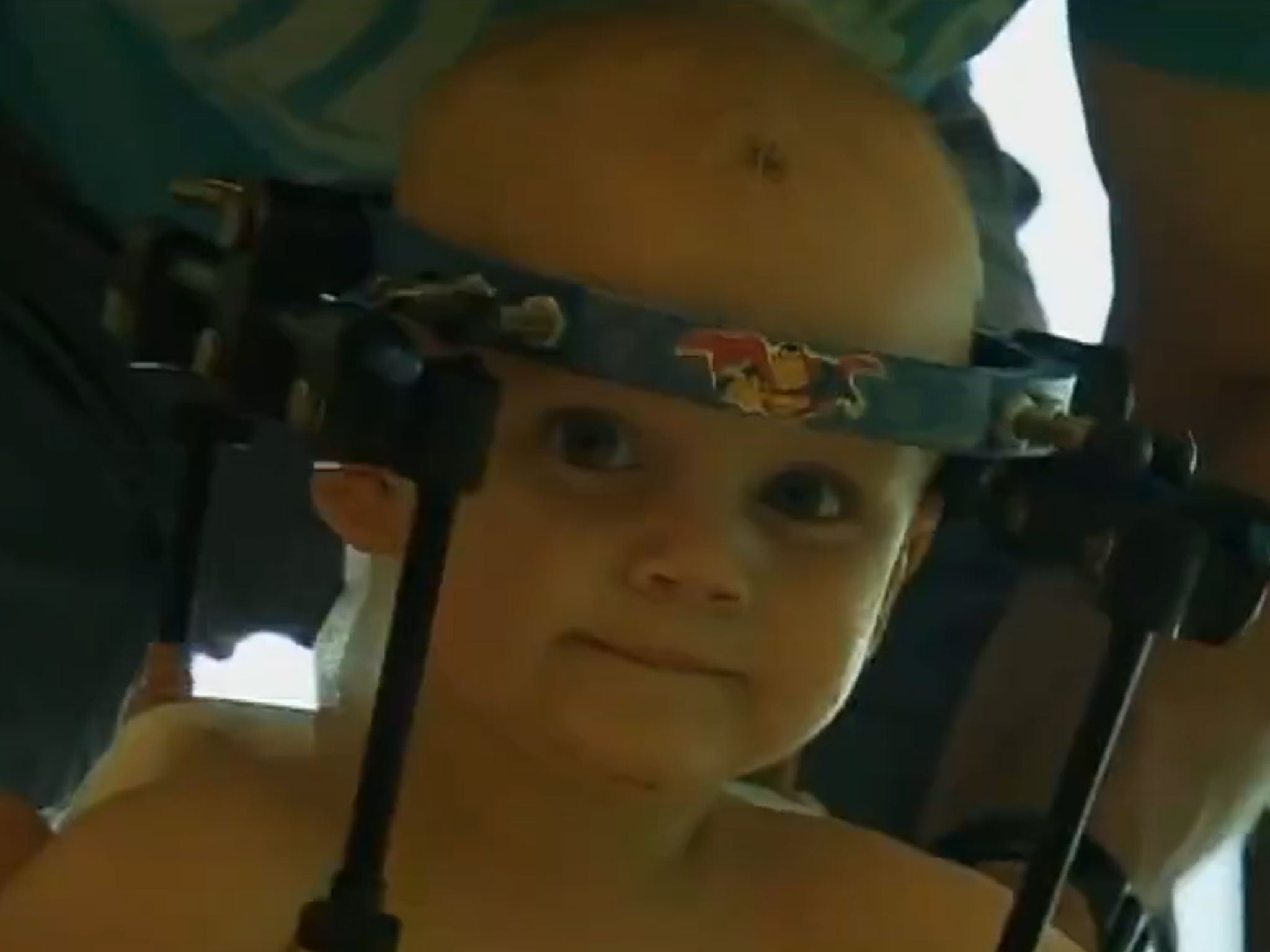 Jaxon Taylor now wears a "halo" to help his vertebrae fuse together.