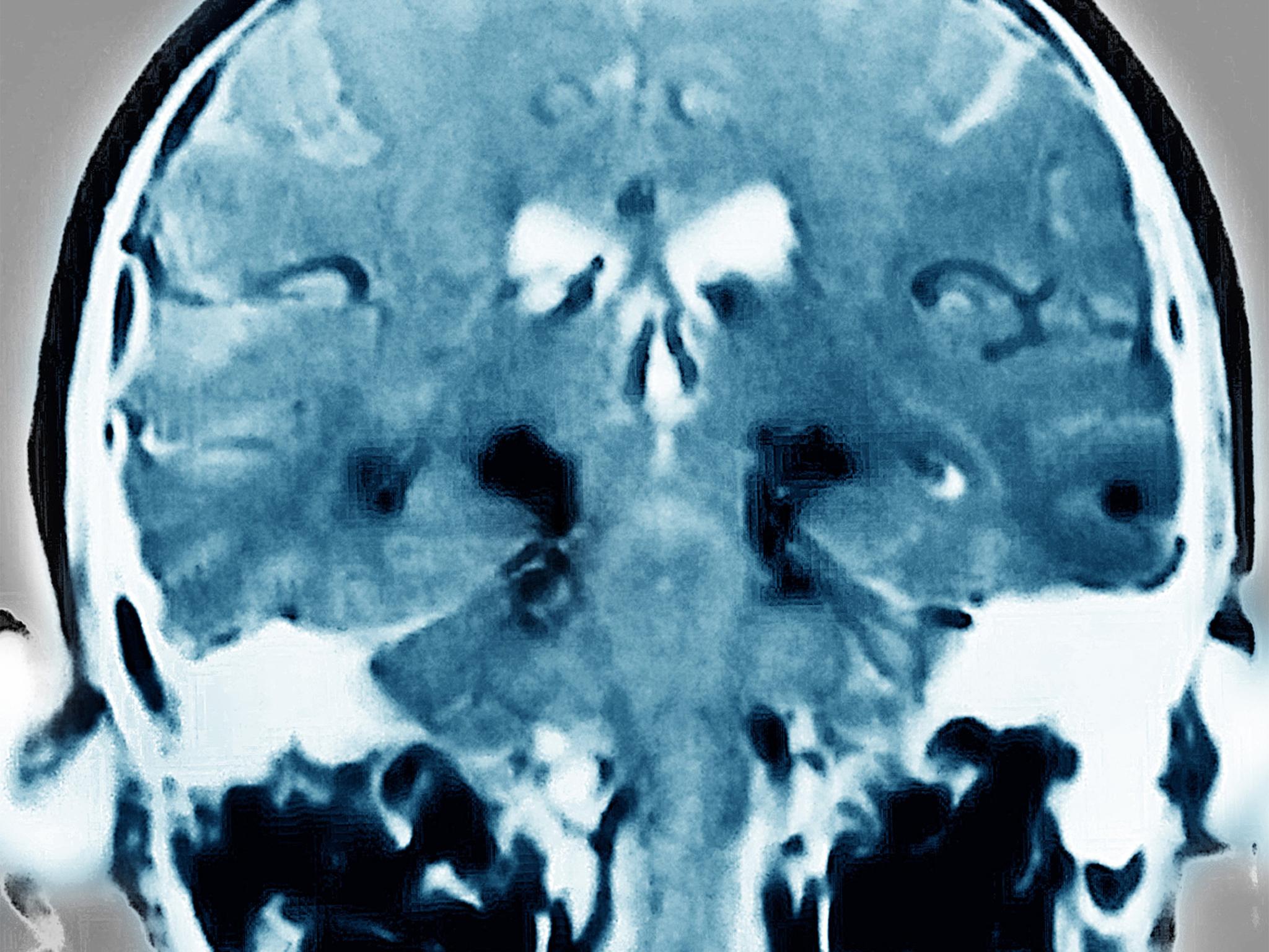 MRI scan of a Parkinson’s patient