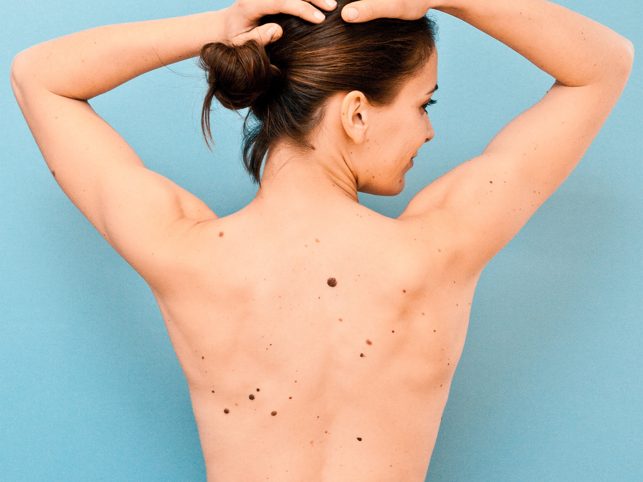 The experts found that the area above the right elbow was particularly predictive of the total body count of moles.