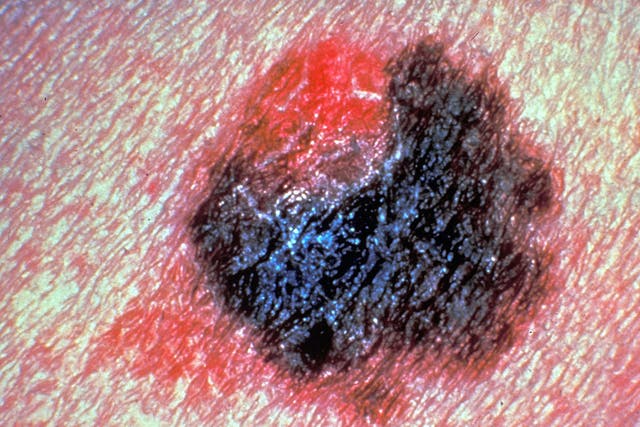Detail of a person with a malignant melanoma