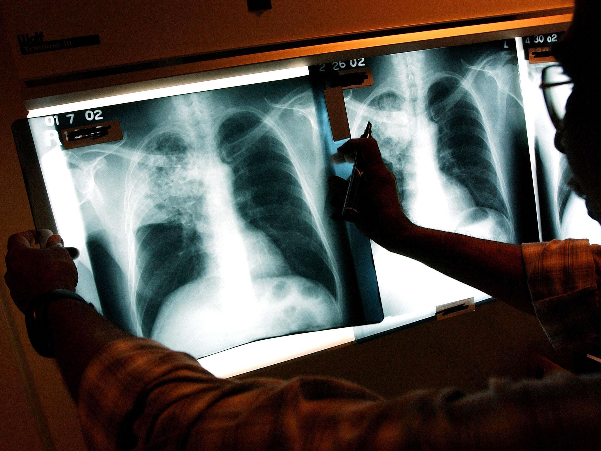 A shadow on the lung: A doctor examines X-rays of a TB patient