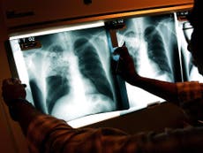 Being diagnosed with tuberculosis, the disease that 'never went away'