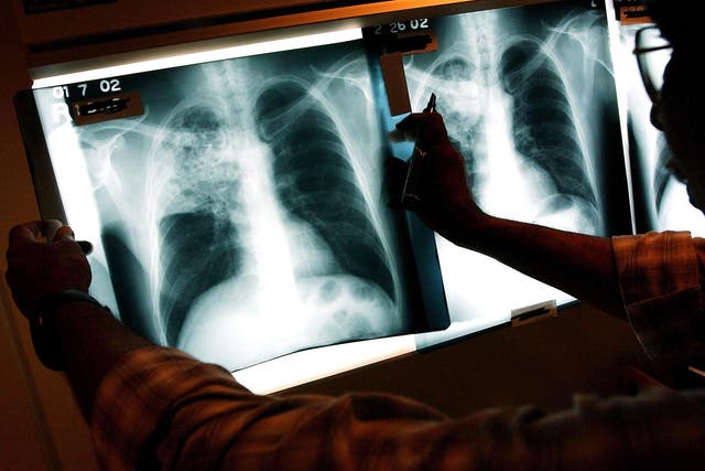 A doctor examines the x-rays of a tuberculosis patient at a clinic