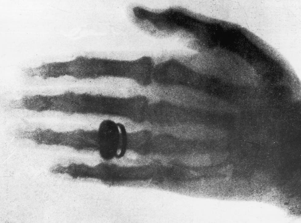 One of the first X-ray photographs, taken by the German physicist Wilhelm Conrad Roentgen, showing his wife's hand