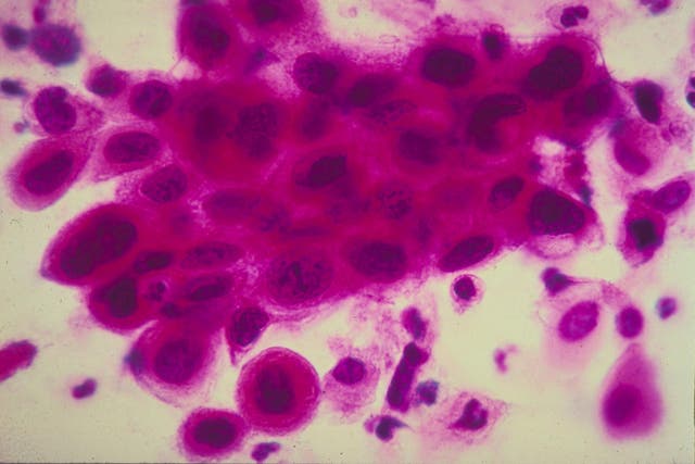 A microscope image of cancer cells in the cervix