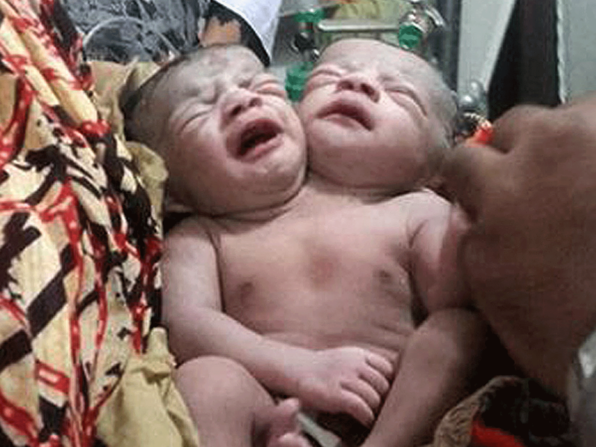 The birth in a hospital near Dhaka, Bangladesh, could be a case of conjoined twins, neurosurgeons have said