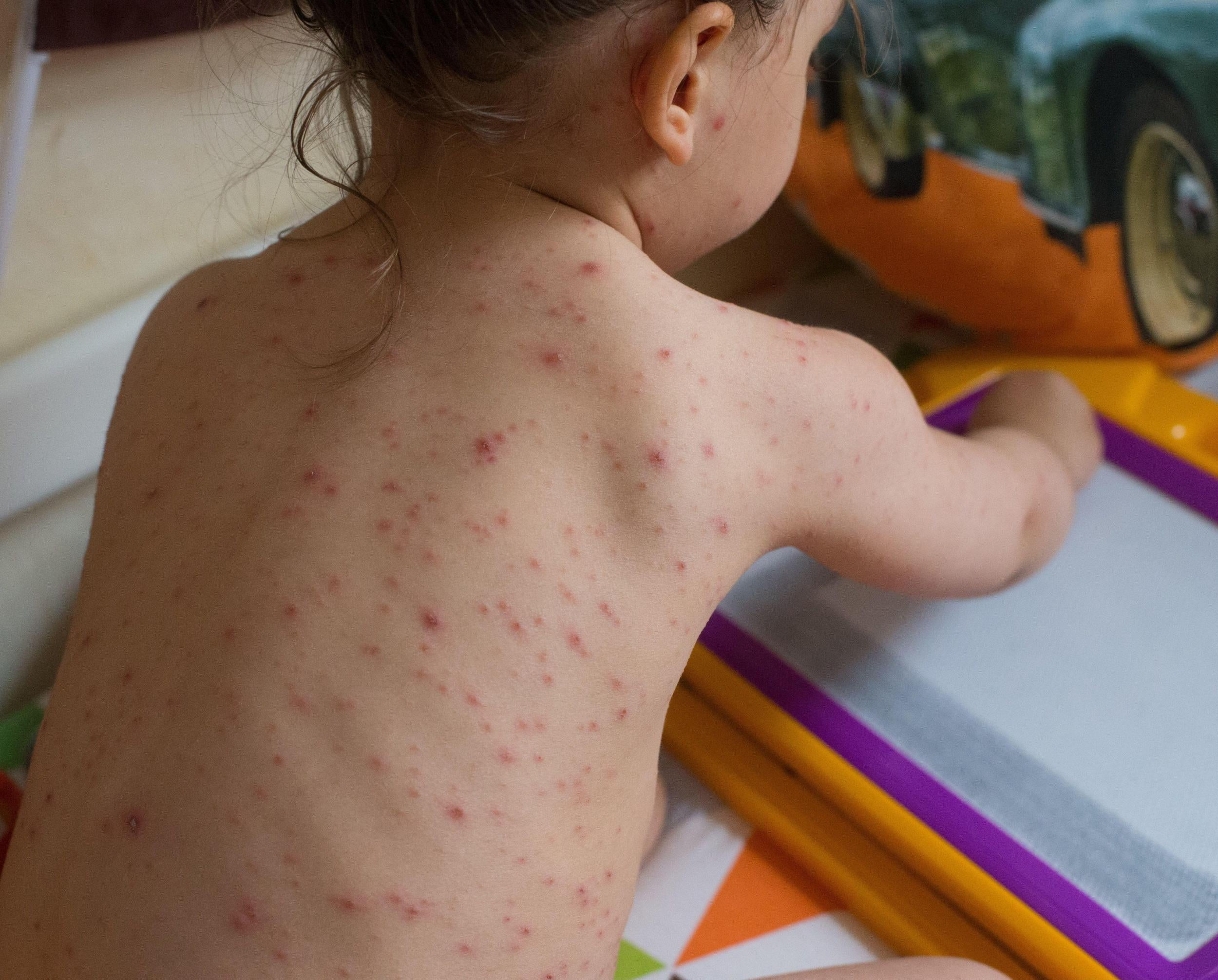 A young child suffering from chickenpox