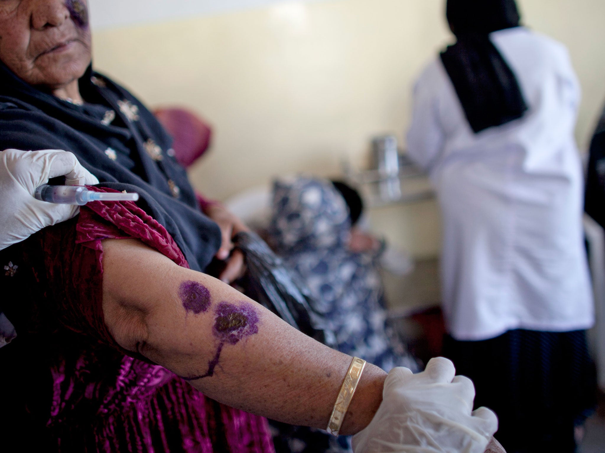 A woman shows signs of the condition on her arm