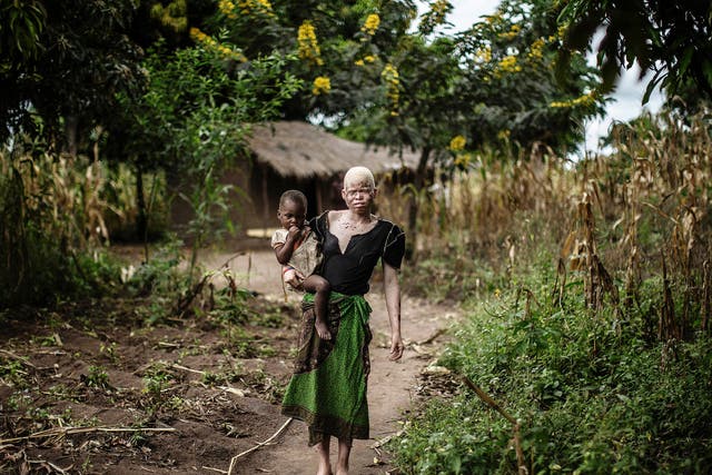 A young albino woman in Malawi, where people with albinism are often stigmatised