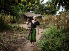 Albino nine-year-old 'decapitated' in Malawi