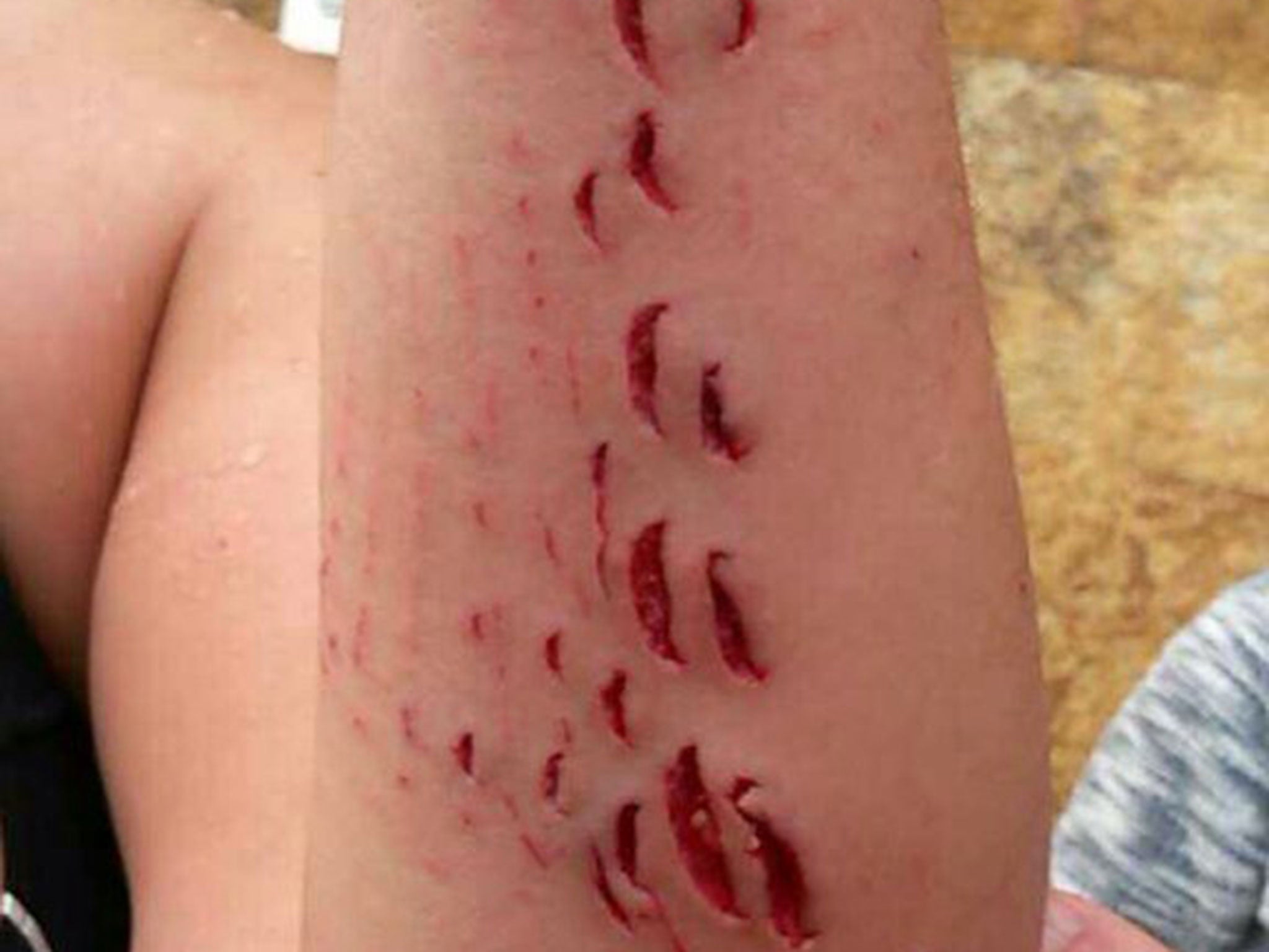 Cristina Ojeda-Thies tweeted a photograph of the shark's tooth-marks on her arm after she was treated in hospital