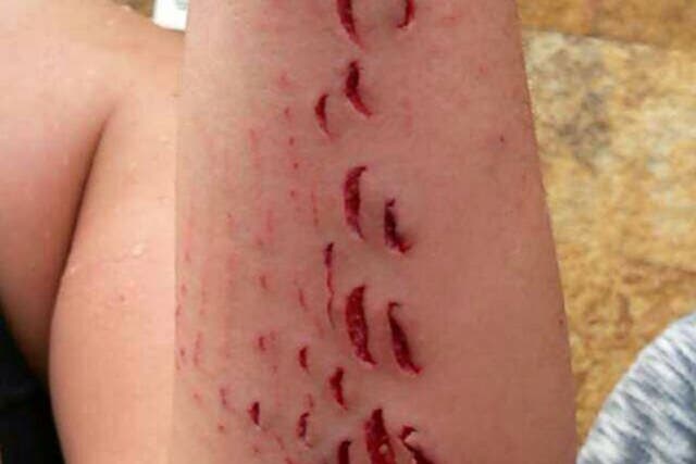 Cristina Ojeda-Thies tweeted a photograph of the shark's tooth-marks on her arm after she was treated in hospital
