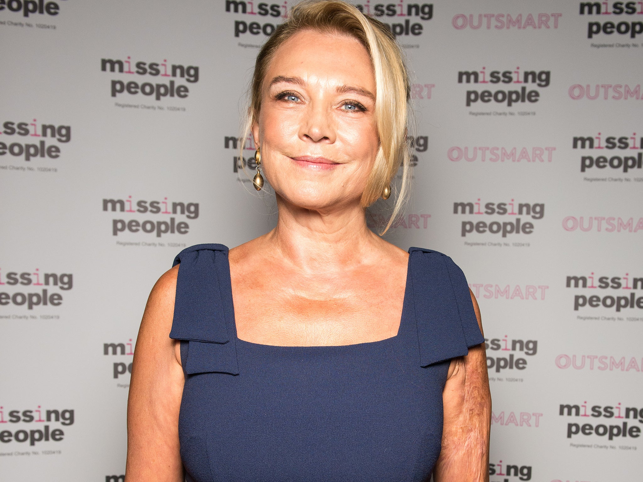 Amanda Redman was treated at St Ormond street at aged 3 for severe burns