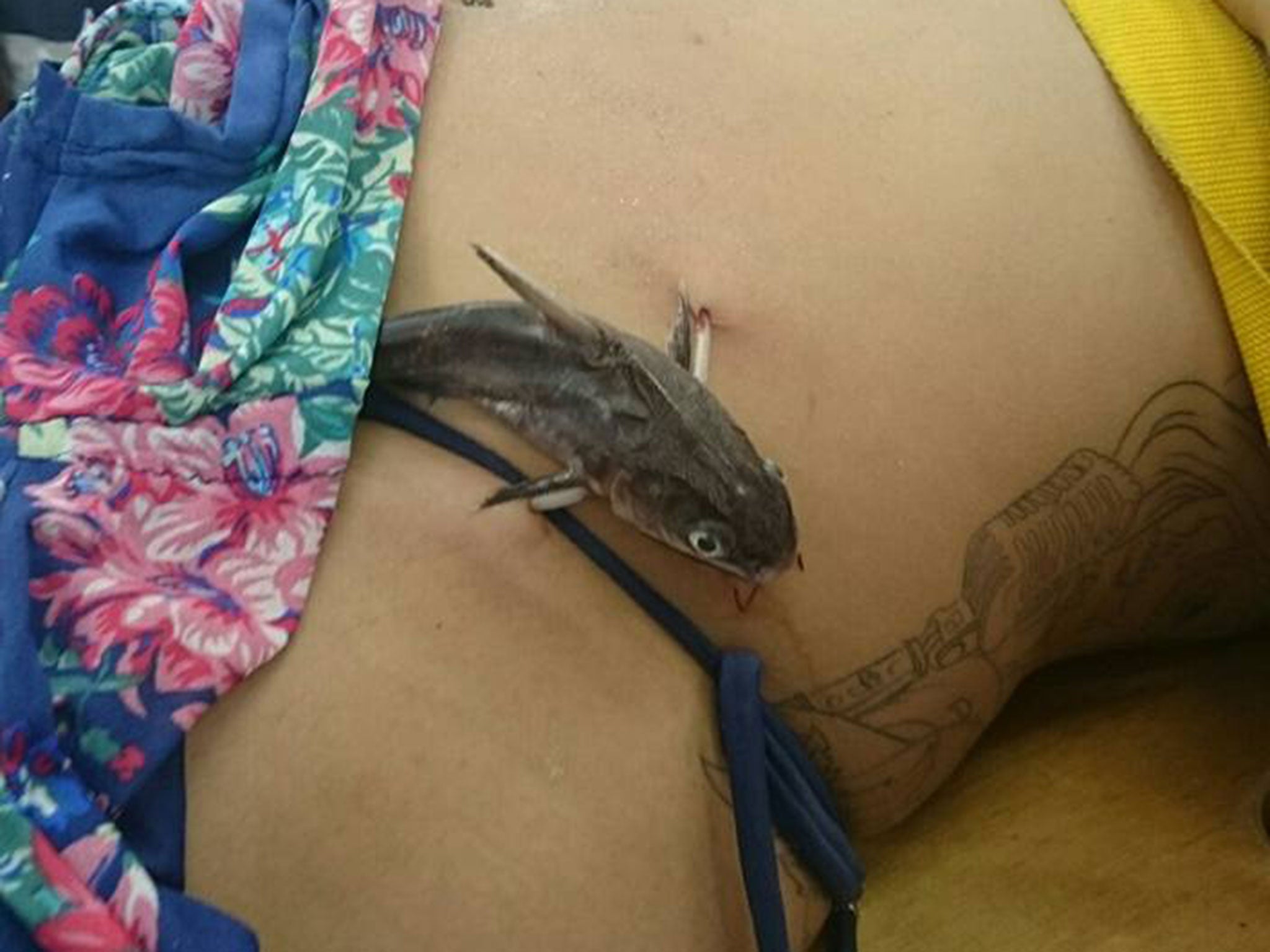 The woman had surgery to remove the catfish embedded in her stomach