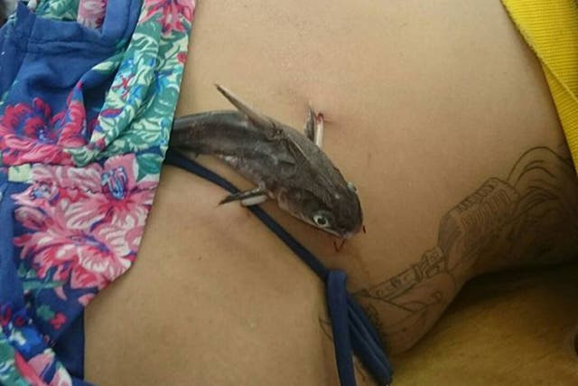The woman had surgery to remove the catfish embedded in her stomach