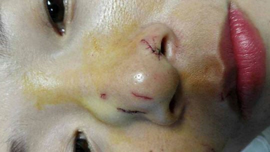 Chinese tourist receives stitches after python bites her nose