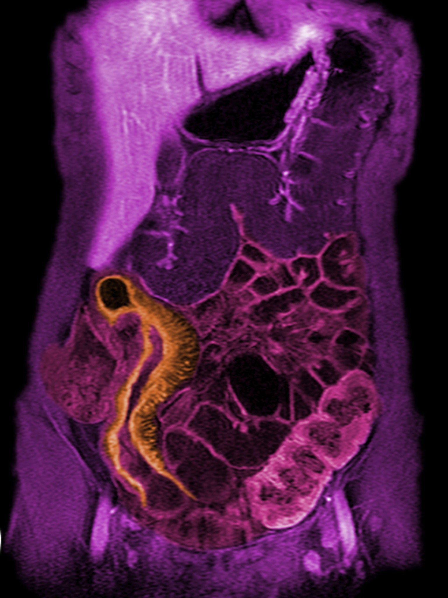 An MRI scan showing the small intestine of a 10-year-old child suffering from Crohn’s disease