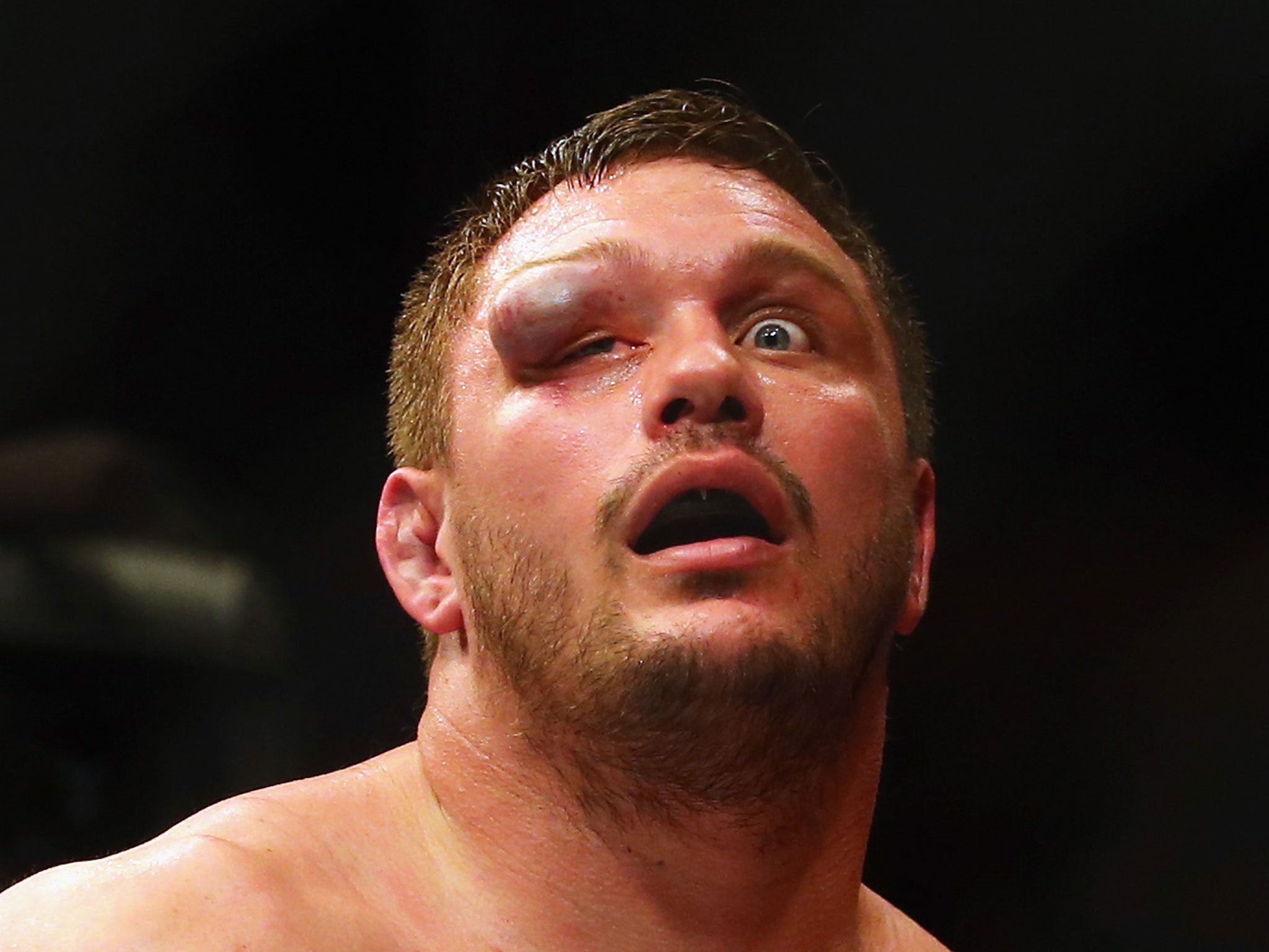 Matt Mitrione suffered a horrific eye injury in his defeat by Travis Browne