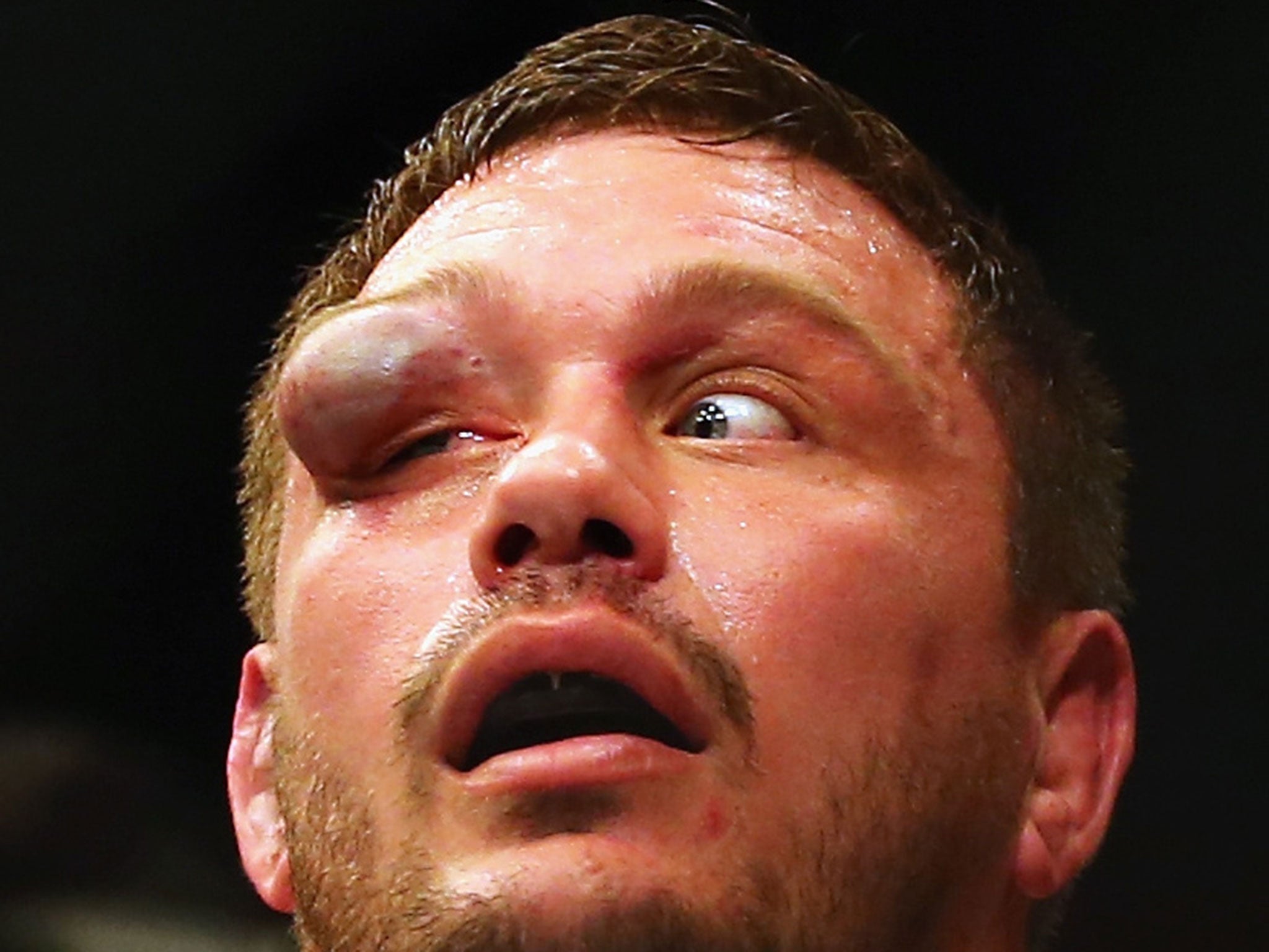 &#13;
Mitrione is left with a badly swollen eye after his loss to Browne&#13;