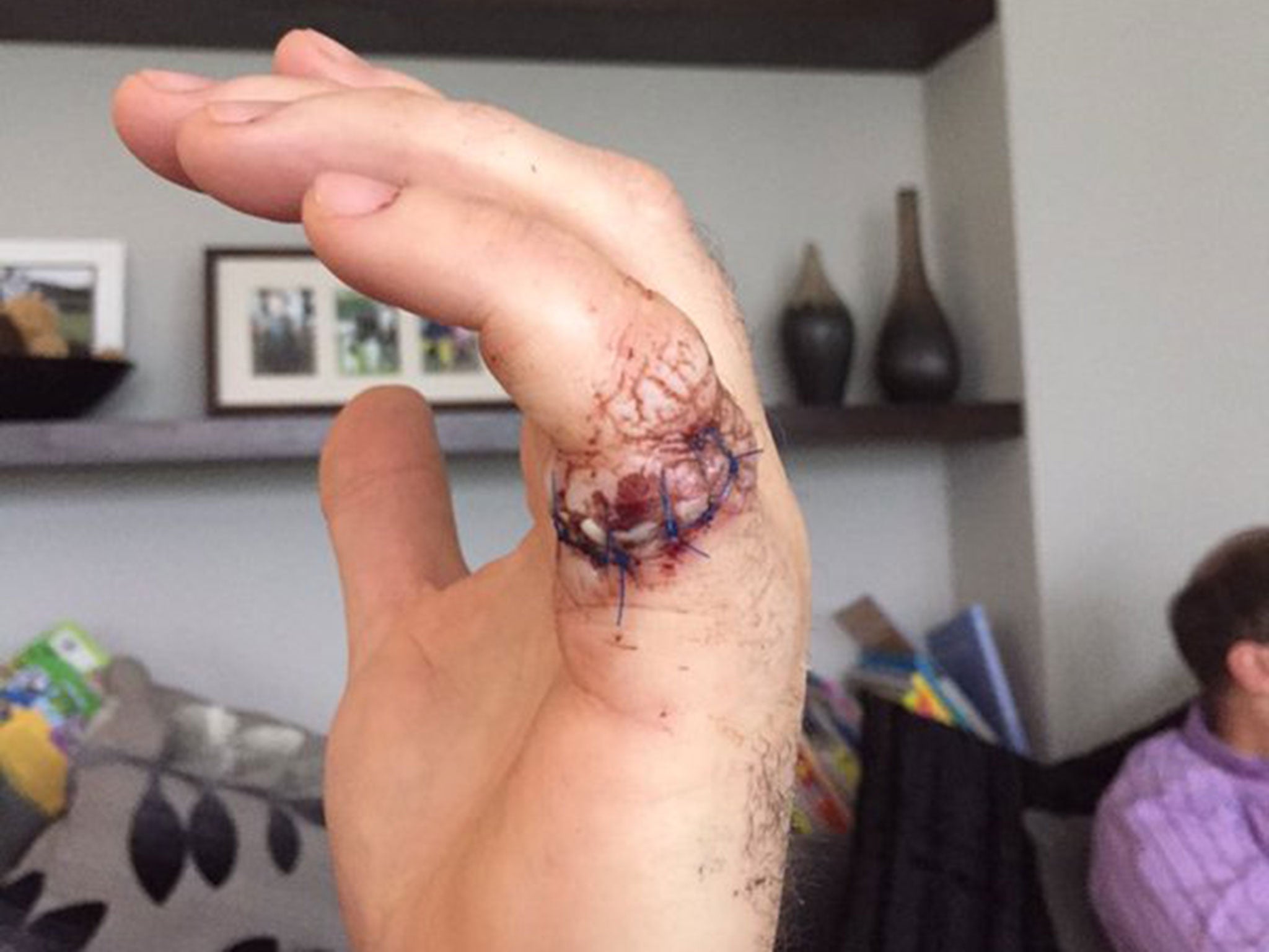 Jamie Donaldson sliced open his finger in a chainsaw accident