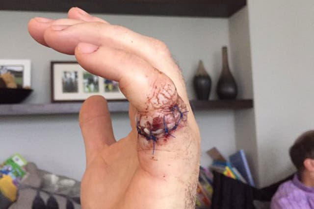 Jamie Donaldson sliced open his finger in a chainsaw accident