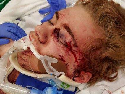 A fall during the challenge crushed Skylar's eye socket and caused him to suffer a brain aneurysm Facebook