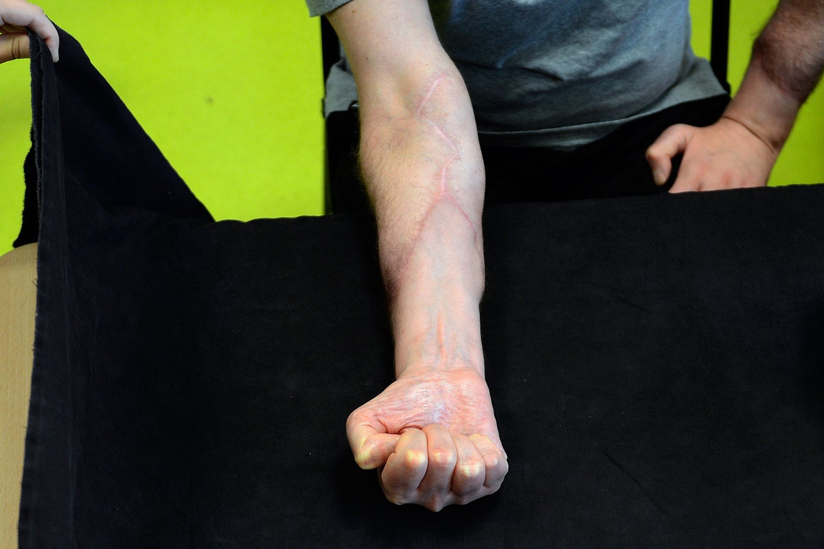 NHS patients to receive first hand and arm transplants | The ...