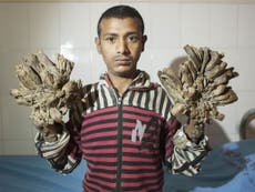 Tree Man’ of Bangladesh has ‘hope’ after surgery