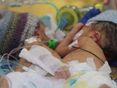 Conjoined twins separated by surgeons at just eight days old