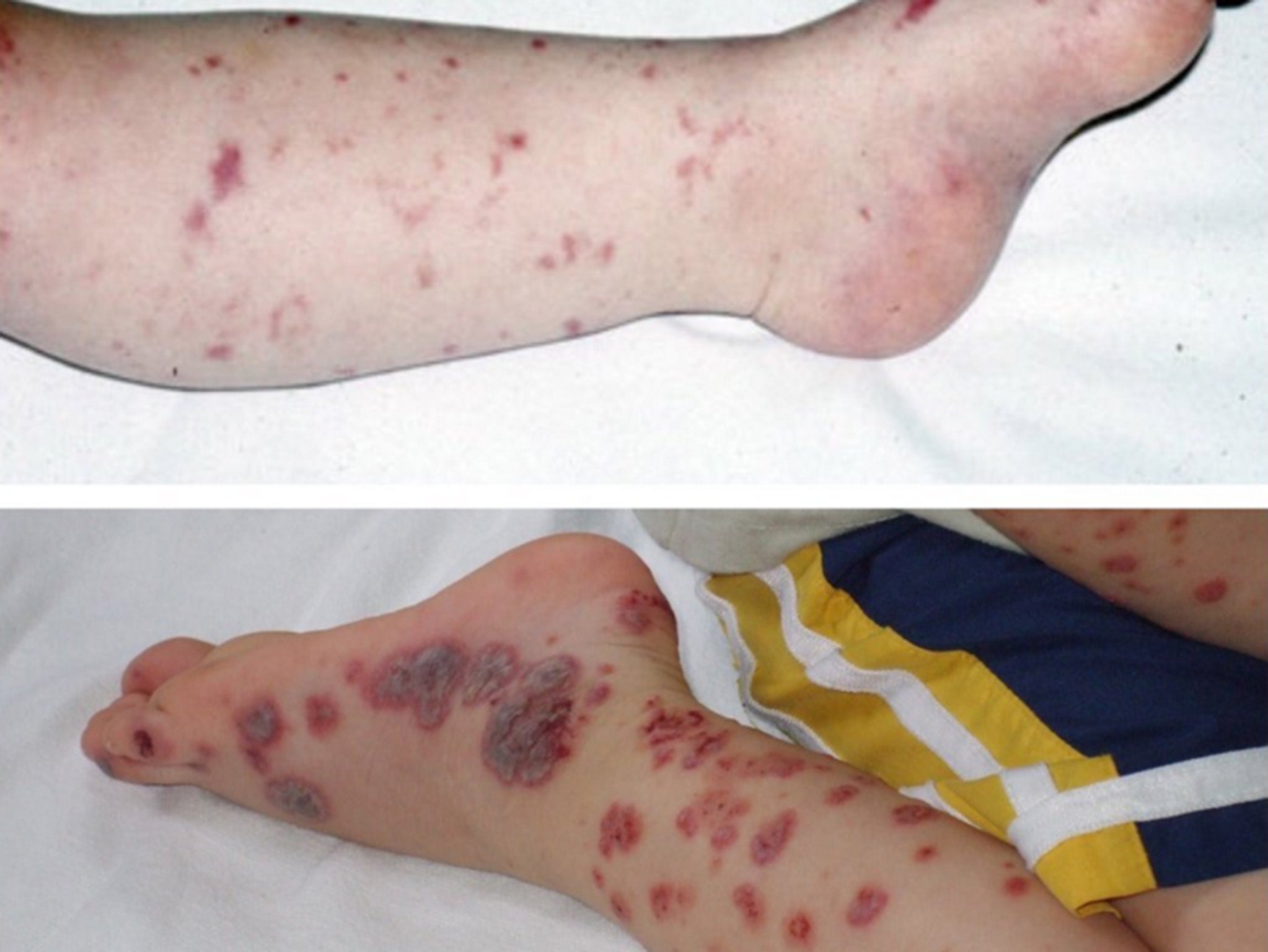 A photo shared on Twitter of different skin rashes