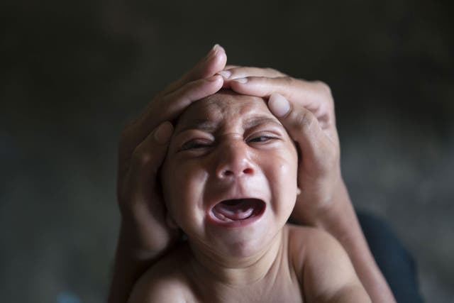 Microcephaly could be one of many conditions linked to the Zika virus
