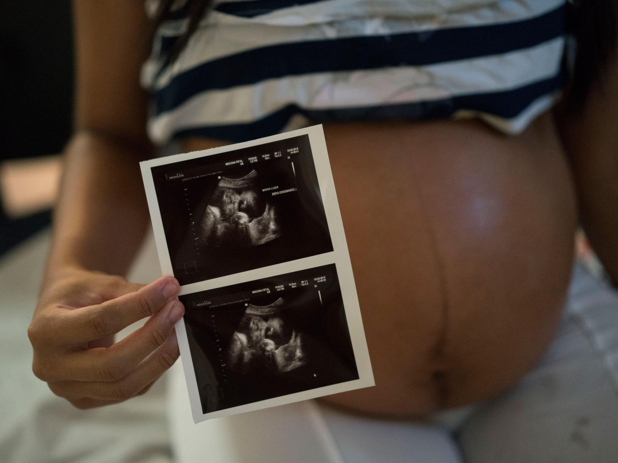 Woman who is six months pregnant, shows a photo of her ultrasound at the IMIP hospital in Recife, Pernambuco state, Brazil