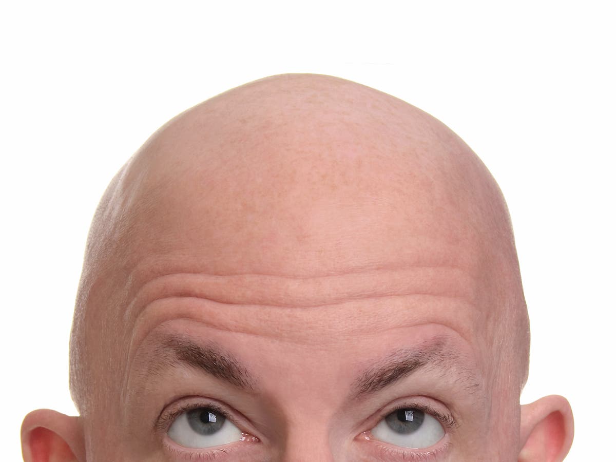 Baldness And Thinning Hair Are Due To Aging Dna Study Finds The Independent The Independent